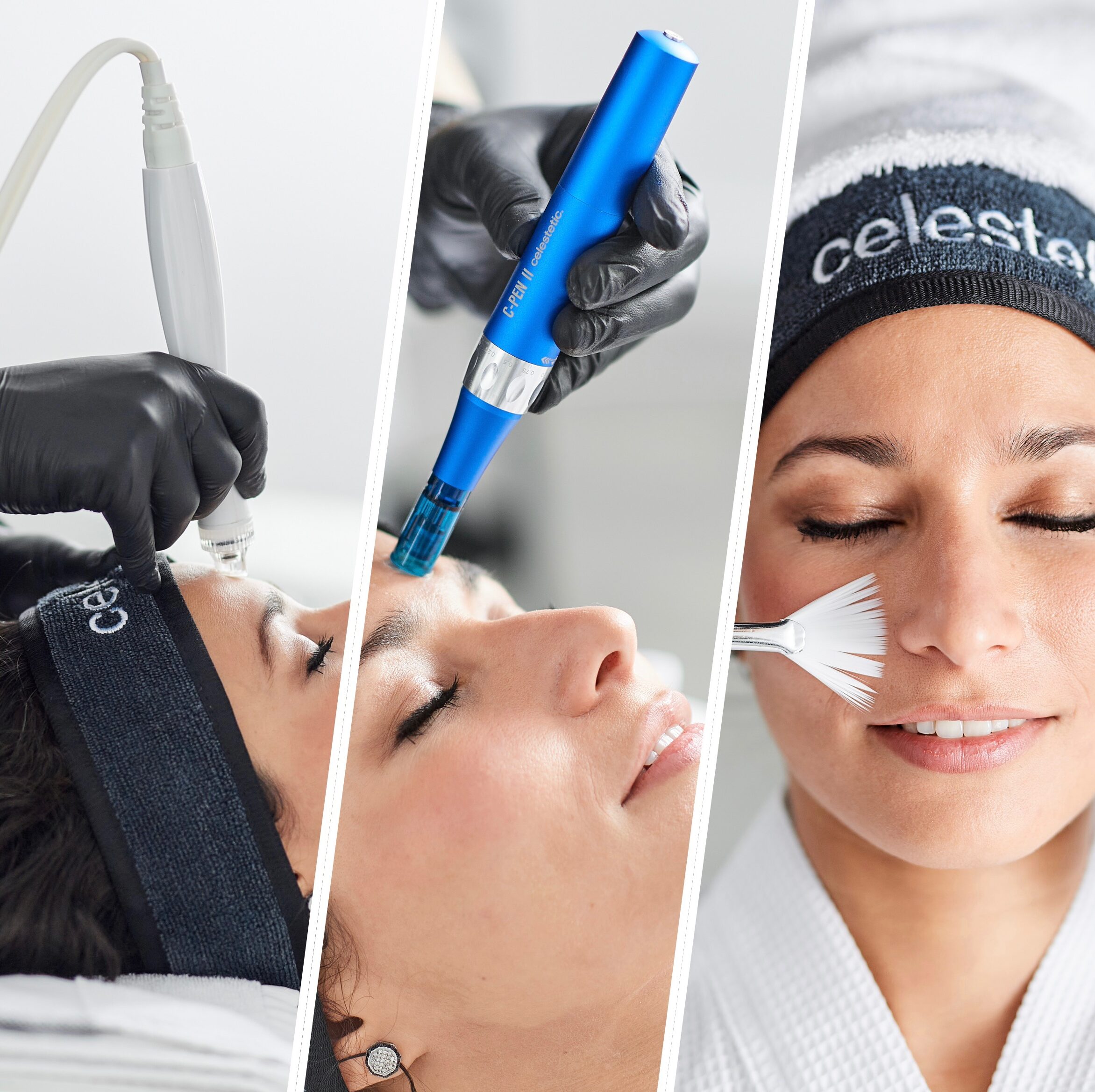 Traitements Techniques Microneedling & Peelings